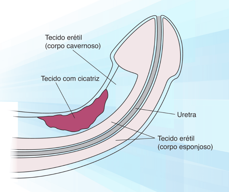 Dr Thiago Cusin - especialista em urologia e tratamento da doença de Peyronie