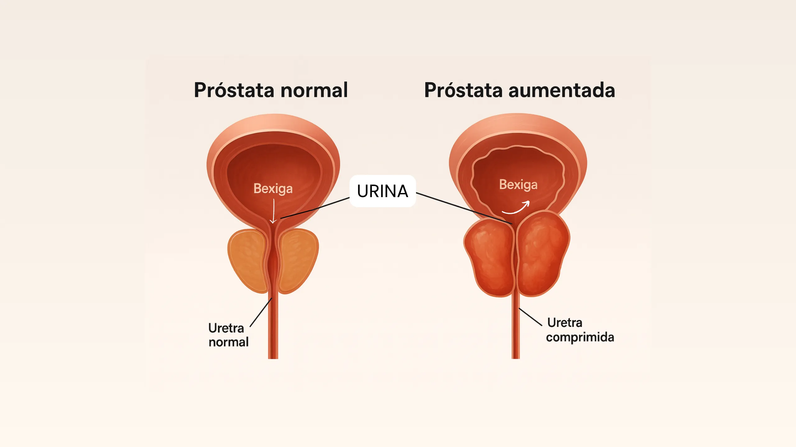 hpb-pr-stata-aumentada-entenda-sintomas-mitos-e-tratamento-dr